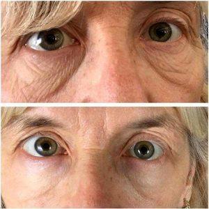 Botox Under Eyes Images (3)