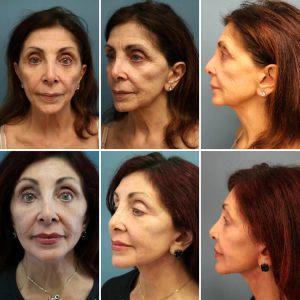Botox Under Neck Before And After