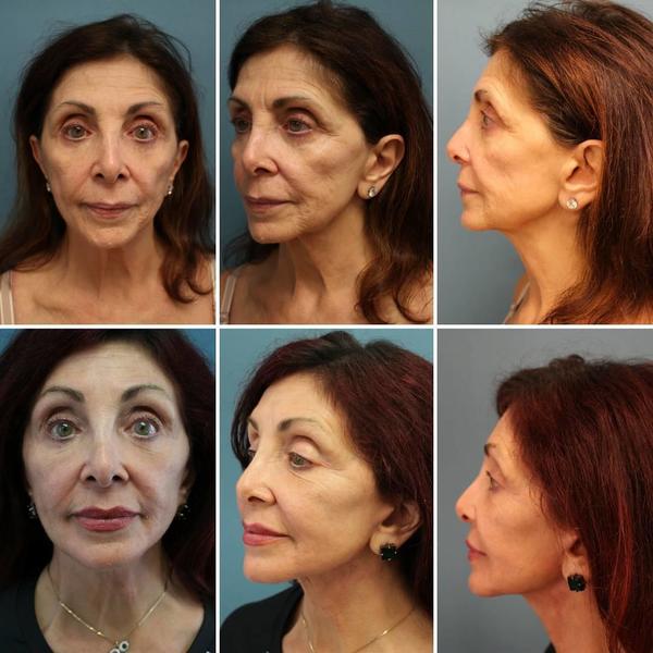 Botox In Neck Before And After