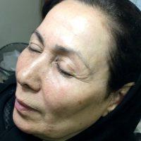 Botox Vs Fillers For Minor Forehead Wrinkles