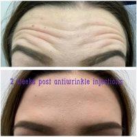 Botox Will Reduce The Appearance Of Forehead Lines