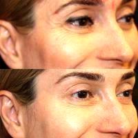 Botox Will Smooth Out Your Crow's Feet
