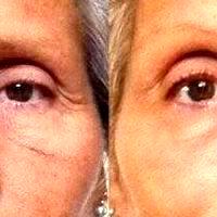 Botox Will Soften The Wrinkles On The Sides Of Your Eyes
