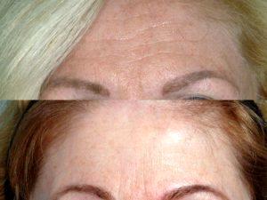 Botox Wrinkles On The Forehead At Gateway Aesthetic Institute And Laser Center,Salt Lake City