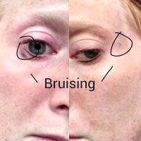 Bruise With Botox