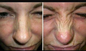 Bunny Lines Botox Before After Pictures (1)