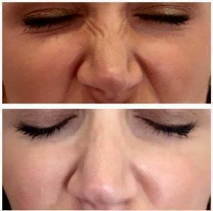 Bunny Lines Botox Before After Pictures (4)