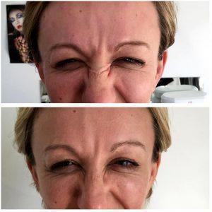 Bunny Lines Botox Treatment Pre And Post Treatment (1)