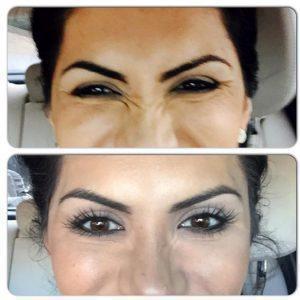 Bunny Lines Botox Treatment Pre And Post Treatment (2)