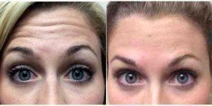 Bye Bye Forehead Wrinkles Before & After With Dr. Marguerite A. Germain, MD, Charleston Dermatologic Surgeon