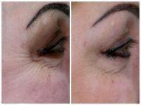 Can Botox Eliminate Crow's Feet