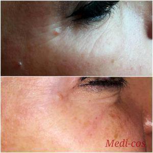 Can Botox Eliminate Crow's Feet Wrinkles