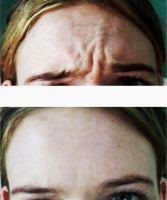 Can Botox Help Deep Frown Lines