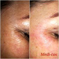 Can Botox Reduce Crows Feet