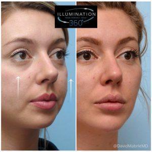 Cheek Treatment With Juvederm Voluma To Create Balanced And Well-defined Cheeks For A More Youthful Appearance By David Mabrie, MD, San Francisco