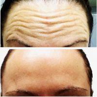Continuous Muscle Contraction Is Another Major Contributor Of Facial Wrinkles