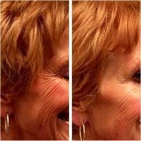 Crows Feet Wrinkles Are Caused By Contraction Of The Muscles