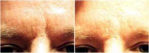 Deep Frown Lines Botox By By Anita Mandal, M.D., Doctor In Palm Beach Gardens, Florida