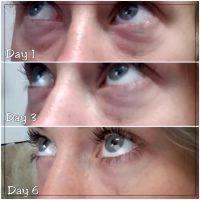 Dermal Fillers Are Great At Improving Under Eye Grooves Or Dark Circles