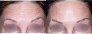 Doctor Alex Eshaghian, MD, PhD, Encino Physician - 44 Year Old Woman Treated With Botox