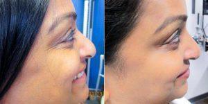 Doctor Angela J. Lamb, MD, New York Dermatologist - 42 Year Old Woman Treated With Preventative Botox