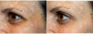 Doctor Brian S. Glatt, MD, FACS, Morristown Plastic Surgeon - 34 Year Old Woman Treated Her Crows Feet With Botox