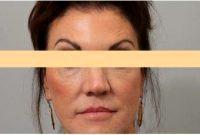 Doctor Connie Hiers, MD, San Antonio Plastic Surgeon - 47 Year Old Woman Treated With Botox