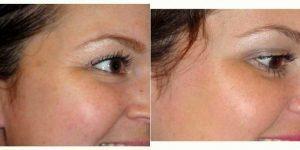 Doctor Daniel Levy, MD, Bellevue Dermatologic Surgeon - 30 Year Old Woman Treated With Botox Around Eyes