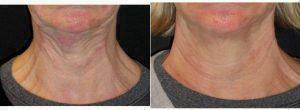 Doctor Daniel Levy, MD, Bellevue Dermatologic Surgeon - 62 Year Old Woman Treated With Botox For Neck Bands