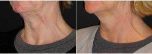 Doctor Daniel Levy, MD, Bellevue Dermatologic Surgeon - 62 Year Old Woman Treated With Botox In Neck Bands