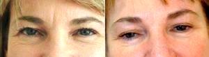 Doctor Harold J. Kaplan, MD, Los Angeles Facial Plastic Surgeon - Botox Forehead Lines (frown Lines)