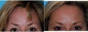 Doctor Jennifer Parker Porter, MD, FACS, Bethesda Facial Plastic Surgeon - 49 Year Old Woman Treated With Botox