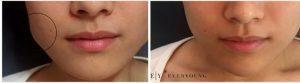 Doctor Jia Zheng, MD, Vancouver Physician - Jawline Slimming On An 18 Yr Old Woman