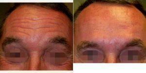 Doctor Karen Beasley, MD, Baltimore Dermatologic Surgeon - 53 Year Old Man Treated With Preventative Botox Forehead