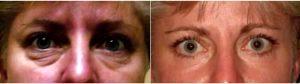 Doctor Kimberly Cockerham, MD, FACS, Stockton Oculoplastic Surgeon - Treated With Botox Under Eyes