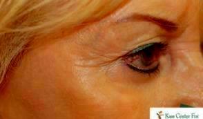 Doctor Lawrence Kass, MD, Saint Petersburg Oculoplastic Surgeon - 54 Year Old Woman Treated With Botox