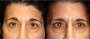 Doctor Leonard Miller, MD, Brookline Plastic Surgeon - Preventative Botox Forehead And Frown Lines