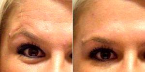 Doctor Peter T. Truong, MD, Fresno Oculoplastic Surgeon - 25 Year Old Woman Treated With Botox Under Eyes