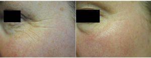 Doctor Renuka Diwan, MD, Cleveland Dermatologic Surgeon - 47 Year Old Woman Treated With Botox For Crows Feet