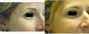 Doctor Renuka Diwan, MD, Cleveland Dermatologic Surgeon - 50 Year Old Woman Treated With Botox For Crows Feet