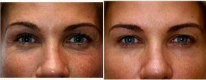 Doctor Richard H. Bensimon, MD, Portland Plastic Surgeon - 27 Year Old Woman Treated With Botox Under Eyes