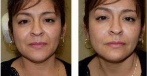 Doctor Ryan Mitchell, DO, FAOCO, Henderson Facial Plastic Surgeon - 38 Year Old Woman Treated With Juvederm To The Nasolabial Folds