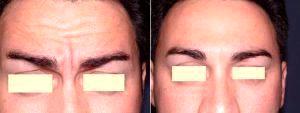 Doctor Scott Trimas, MD, Jacksonville Facial Plastic Surgeon - Botox 11 Lines