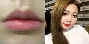 Doctor Seung Ryong Lee, MD, South Korea Plastic Surgeon - 22 Year Old Woman Treated With Botox For Lips