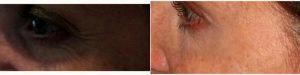 Doctor Theodore Lazzaro, MD, Greensburg Plastic Surgeon - 43 Year Old Woman Treated With Botox Under Eyes