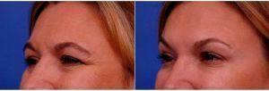 Doctor Thomas J. Walker, MD, Atlanta Facial Plastic Surgeon - 54 Year Old Woman Treated With Botox, Treatment Areas Include Glabella, Forehead, And Crows Feet