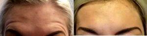 Doctor Todd Christopher Hobgood, MD, Phoenix Facial Plastic Surgeon - 28 Year Old Woman Treated With Botox
