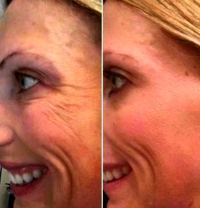 Doctor Todd Christopher Hobgood, MD, Phoenix Facial Plastic Surgeon - 31 Year Old Woman Treated With Botox