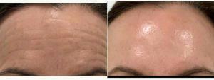 Doctor Tracy Evans, MD, FAAD, San Francisco Dermatologic Surgeon - 54 Year Old Woman Treated With Botox