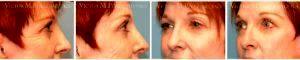 Doctor Victor M. Perez, MD, FACS, Kansas City Plastic Surgeon - 59 Year Old Woman Treated With Botox